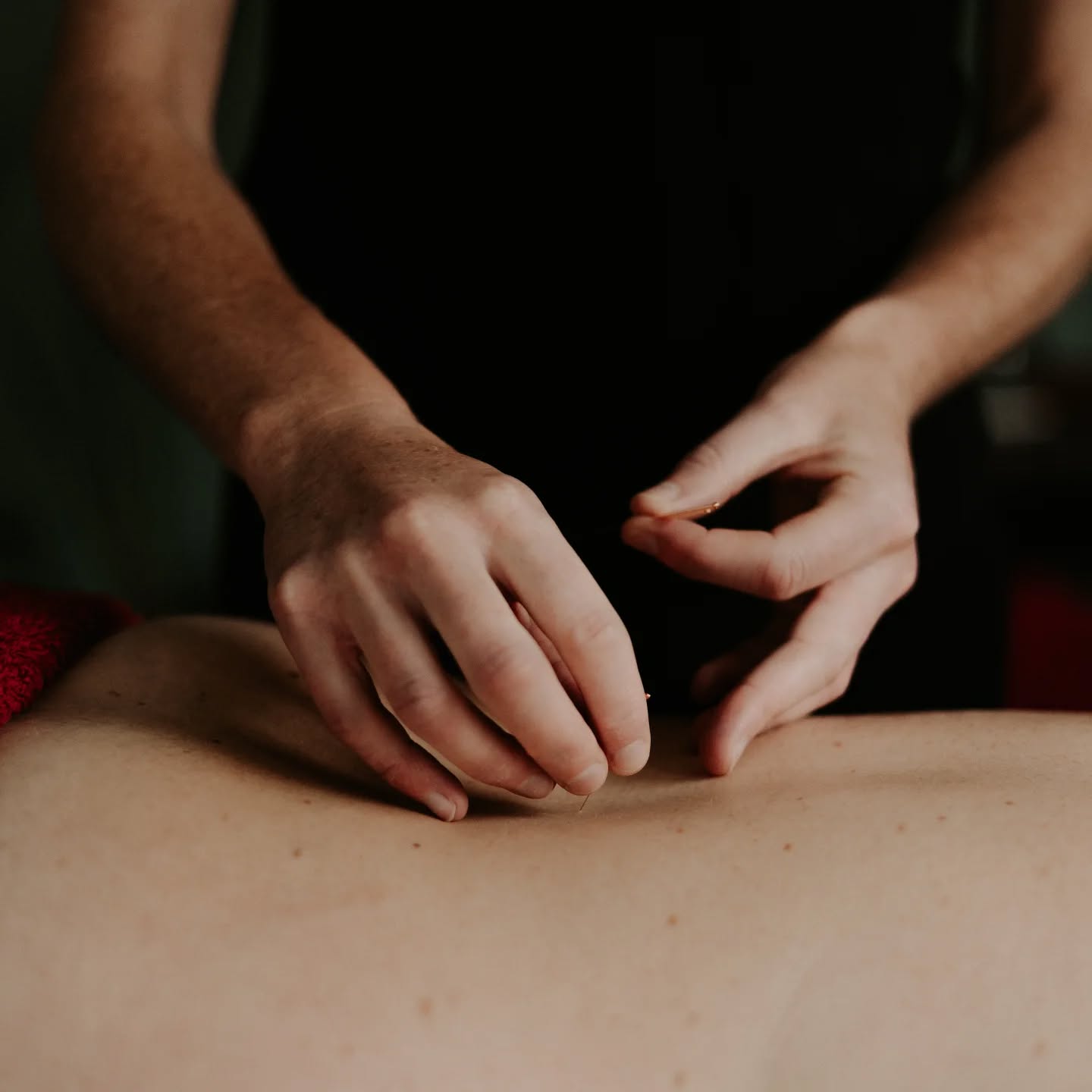 Dry needling treatment